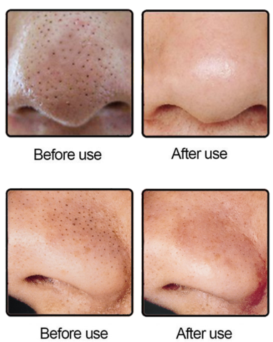 MICRO PORE VACCUME SET