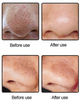 MICRO PORE VACCUME SET